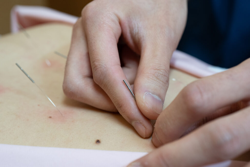 ひたちなか市で自律神経症状でお悩みの方への鍼灸施術